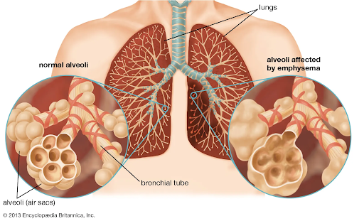 What is Chronic Obstructive Pulmonary Disease (COPD),Causes & How to Manage it